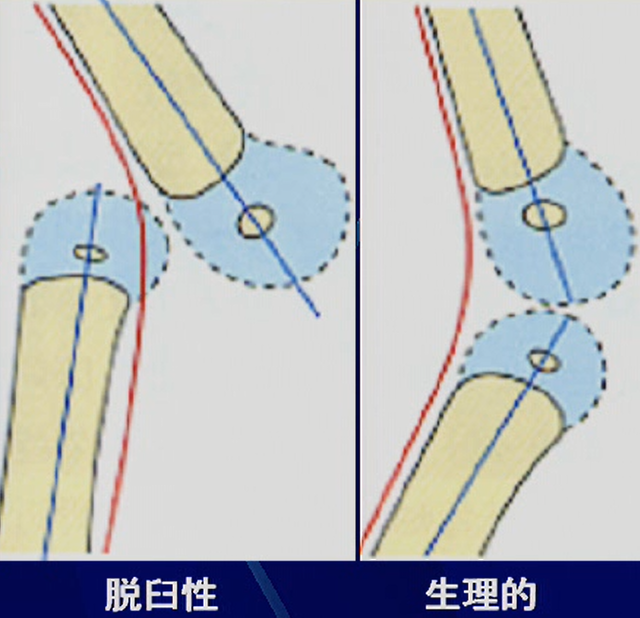 反張膝