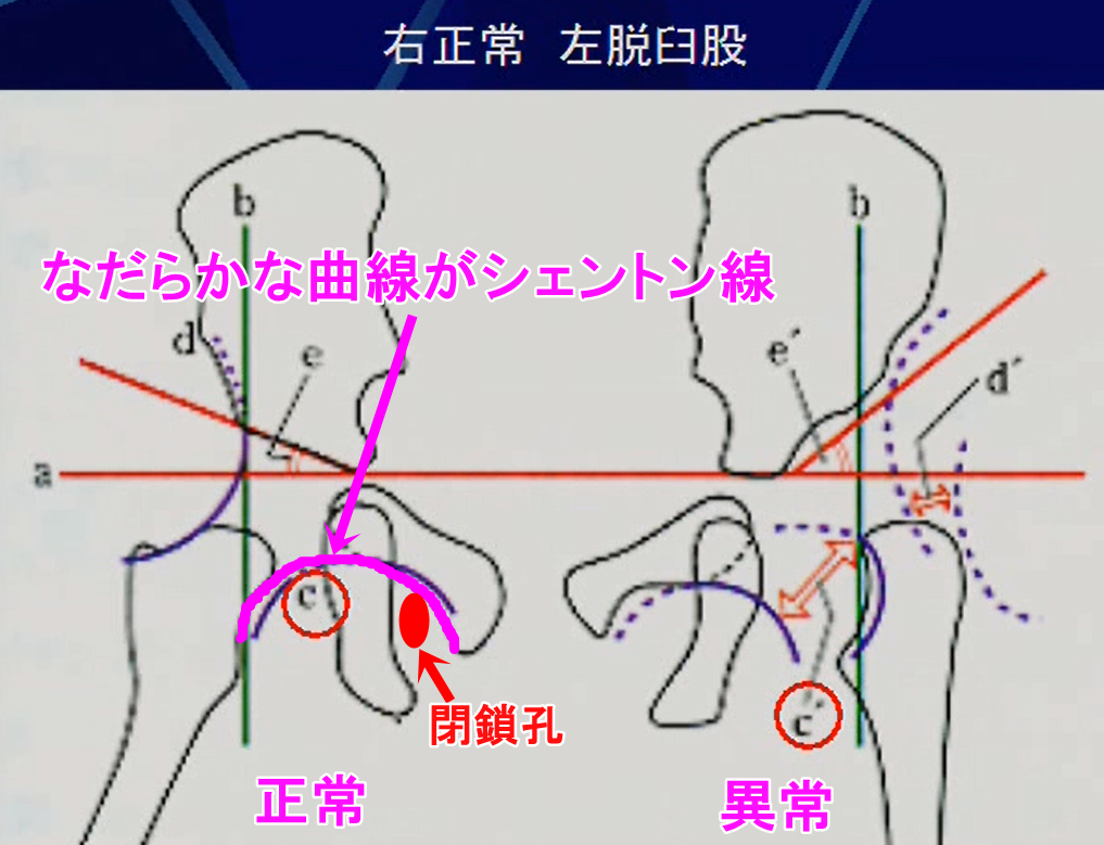 シェントン線