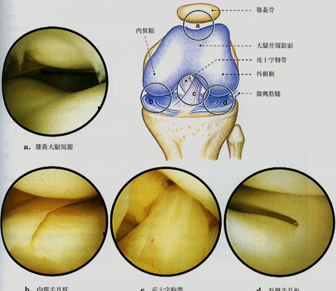 半月板損傷を関節鏡で検査