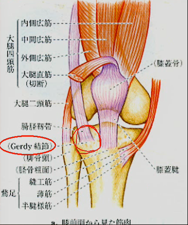 前十字靭帯(ＡＣＬ)損傷の画像