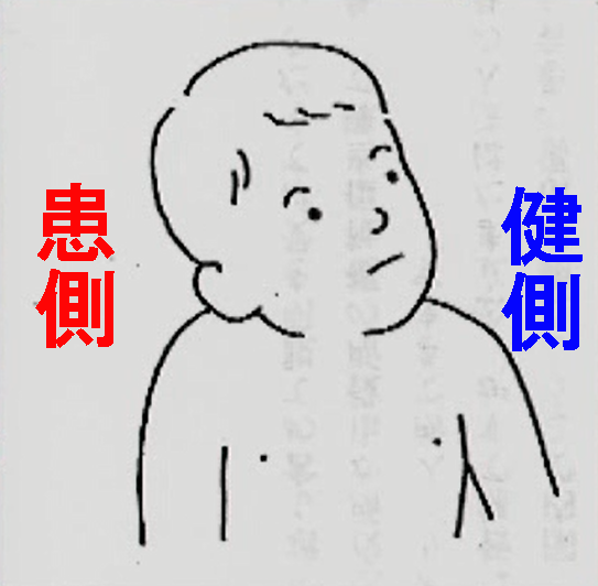 斜頚