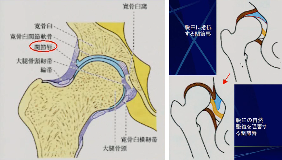 関節唇