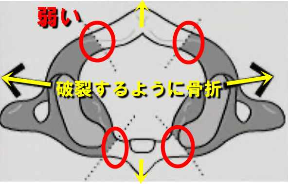 ①破裂骨折(ジェファーソン骨折) 例)頭から転落し軸圧によって骨折することです。