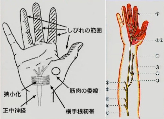 鑑別疾患　手根管症候群