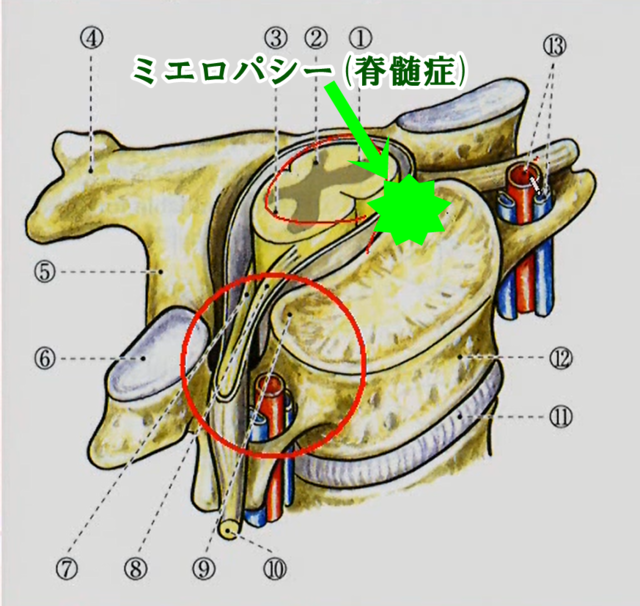 ミエロパシー(脊髄症)とは