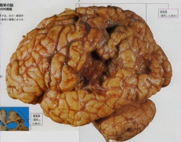 脳血管性認知症