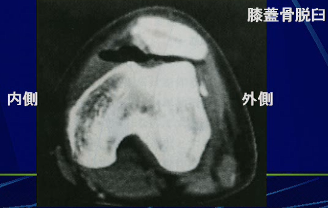 膝蓋骨も脱臼する