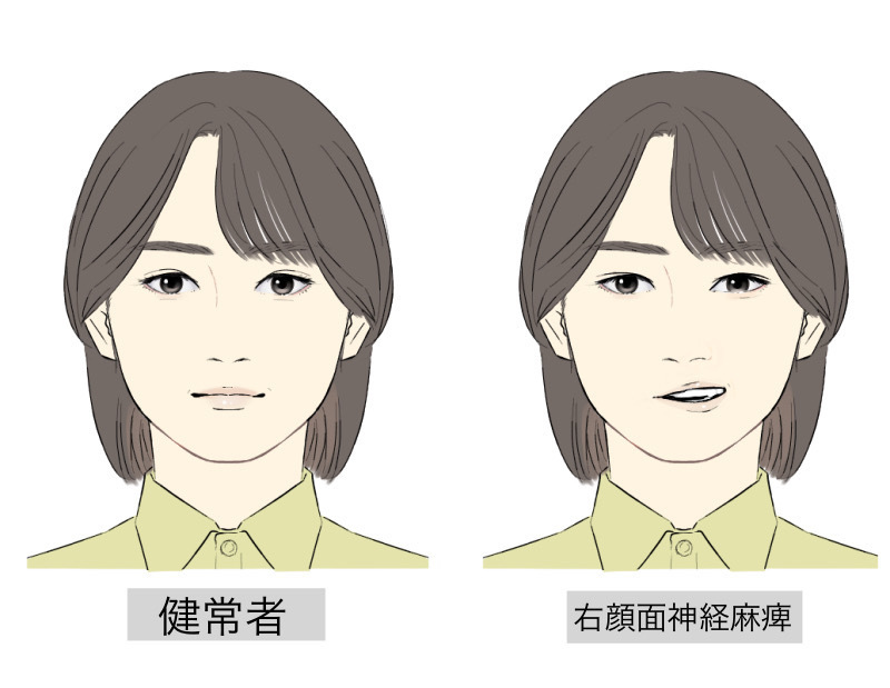 顔面神経麻痺の【初期症状】