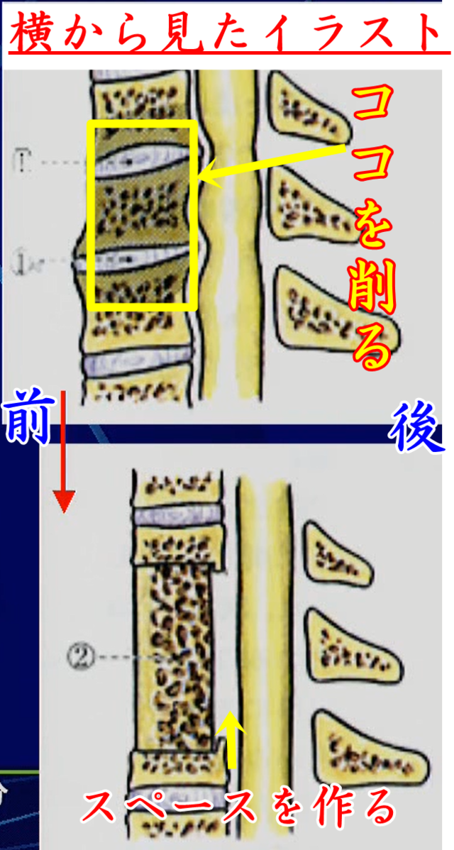 前方除圧・固定