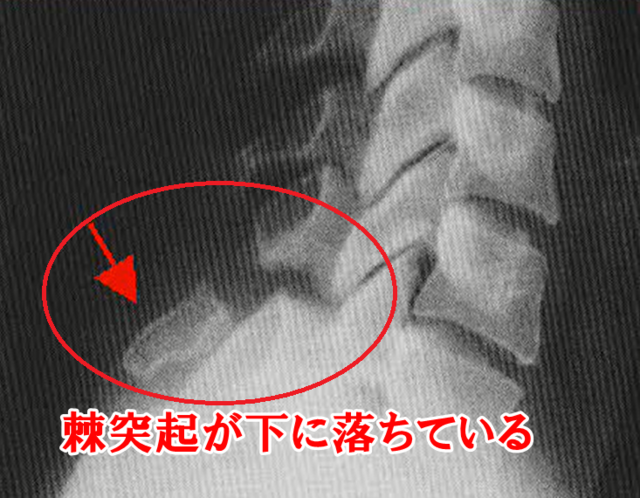 シャベル作業者骨折