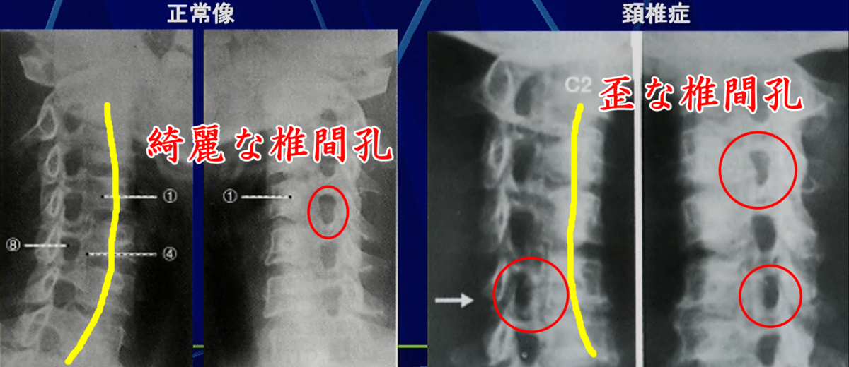 斜位像による椎間孔狭窄の様子