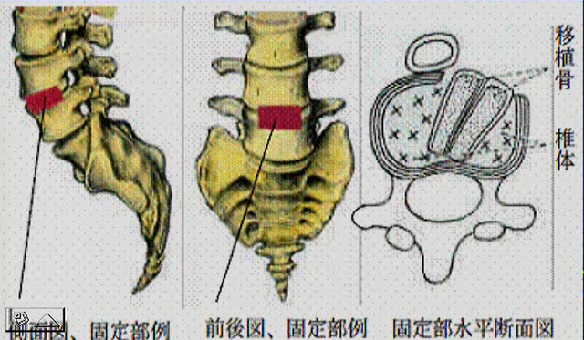 前方椎間板摘出術