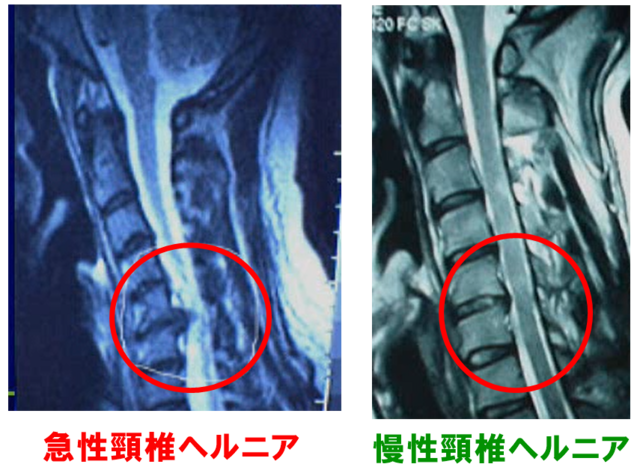 頸椎ヘルニア急性と慢性