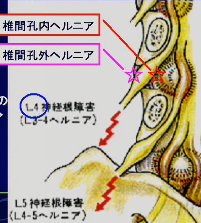 圧迫される神経根の例外