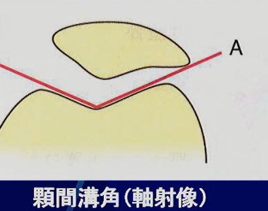 反張膝