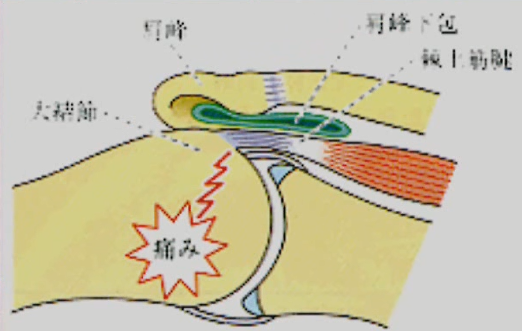 肩峰下インピンジメント症候群