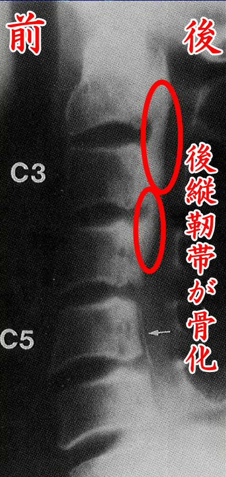 後縦靭帯骨化の合併