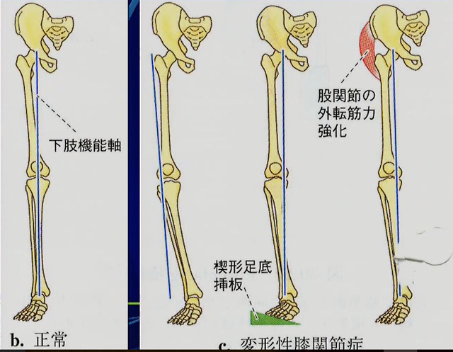 荷重を外側コンパートメントへ移動させる方法