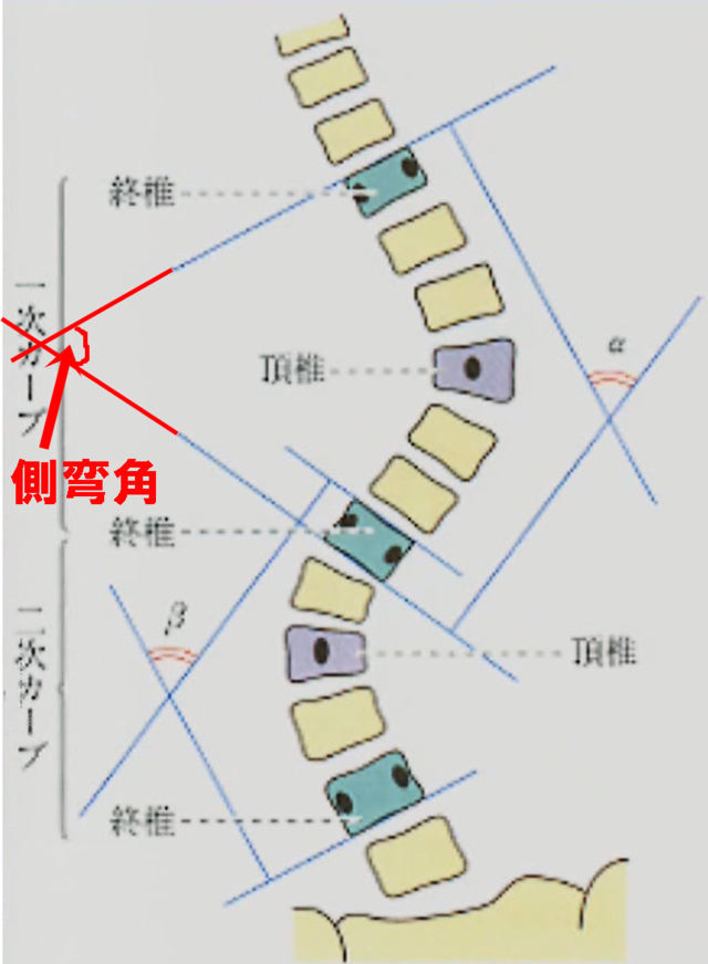 側弯角　コブ角