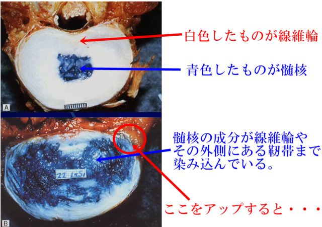 椎間板ヘルニア