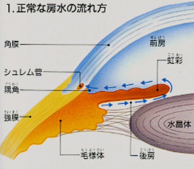 緑内障