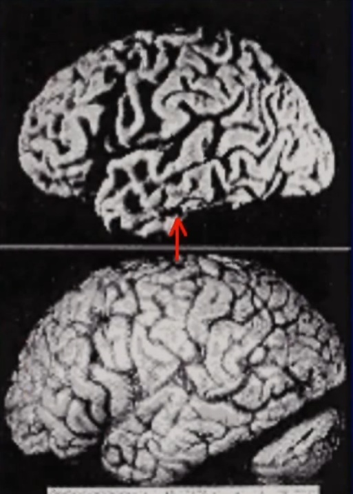 脳血管性認知症