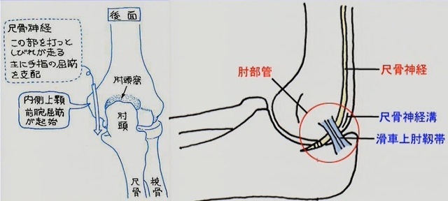 鑑別疾患　肘部管症候群