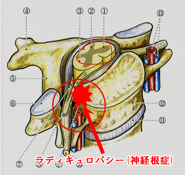 ラディキュロパシー(神経根症)とは