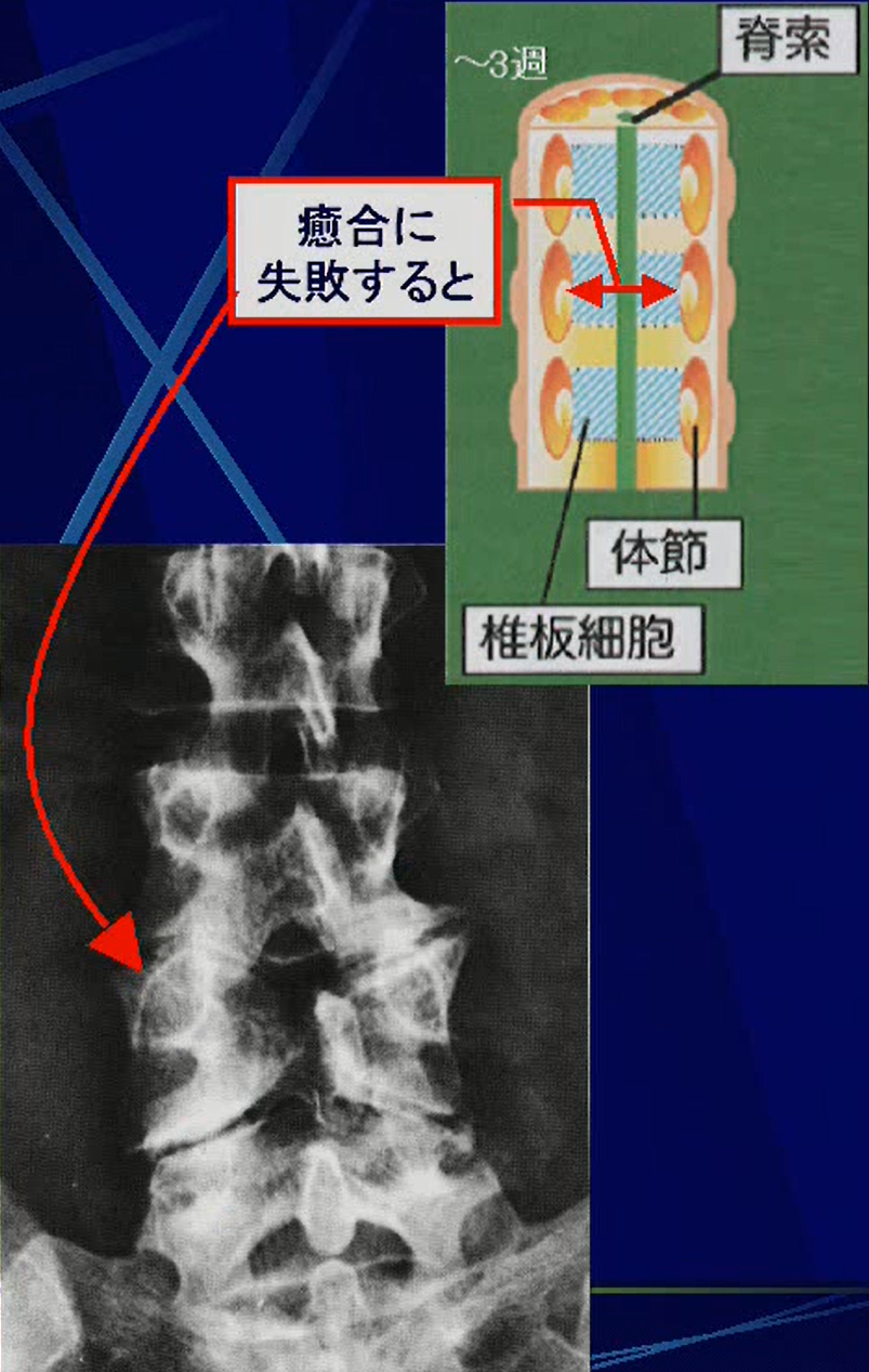 脊椎の形成異常 整形外科学ブログ 品川区の整体 産後の骨盤矯正と痛くない小顔矯正が口コミで人気のなかのぶ整体院