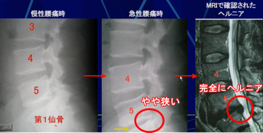 椎間板退行変性の画像