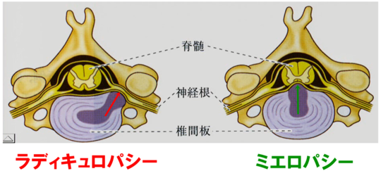 頸椎椎間板ヘルニアについて 整形外科学ブログ 品川区の整体 産後の骨盤矯正と痛くない小顔矯正が口コミで人気のなかのぶ整体院 頸椎椎間板ヘルニアについて 整形外科学ブログ 品川区の整体 産後の骨盤矯正と痛くない小顔矯正が口コミで人気のなかのぶ整体院