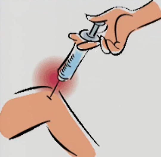副腎皮質ステロイドの関節内注射