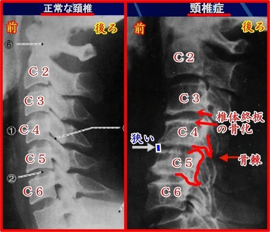 頚椎症の画像所見(ヘルニアと違う点)
