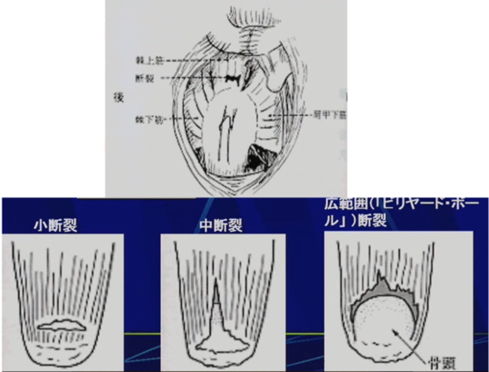 全層(完全)断裂