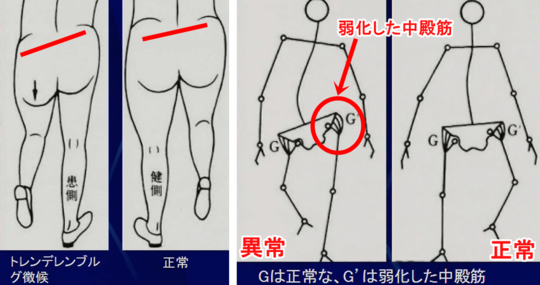 トレンデレンブルグ徴候(サイン)