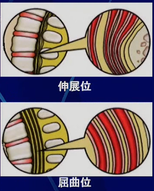 腰椎症　神経性間欠跛行