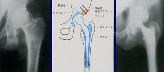 セメント使用型