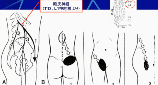 メイン症候群