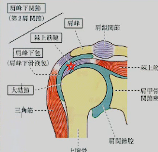 腱板断裂
