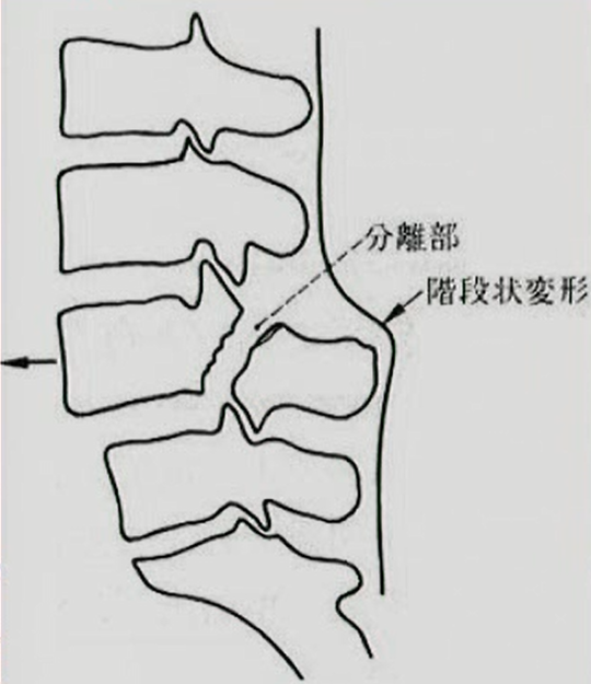 分離すべり