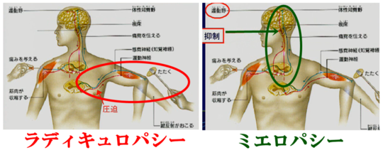 頸椎椎間板ヘルニアについて 整形外科学ブログ 品川区の整体 産後の骨盤矯正と痛くない小顔矯正が口コミで人気のなかのぶ整体院 頸椎椎間板ヘルニアについて 整形外科学ブログ 品川区の整体 産後の骨盤矯正と痛くない小顔矯正が口コミで人気のなかのぶ整体院